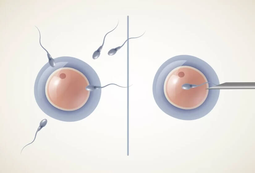 ICSI Success Rates in Delhi | Dr Rhythm Gupta - Excel IVF