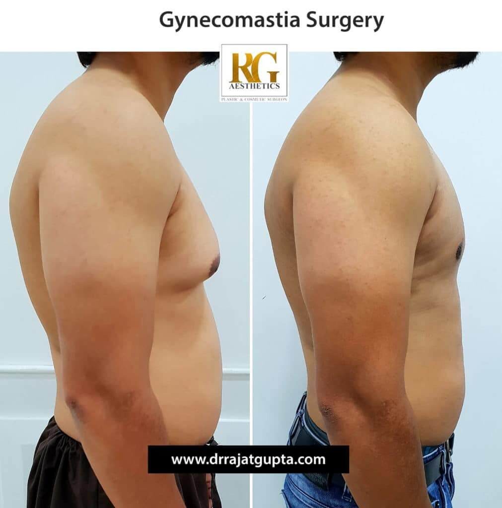The OCCULT Technique for Gynecomastia – Dr Rajat Gupta