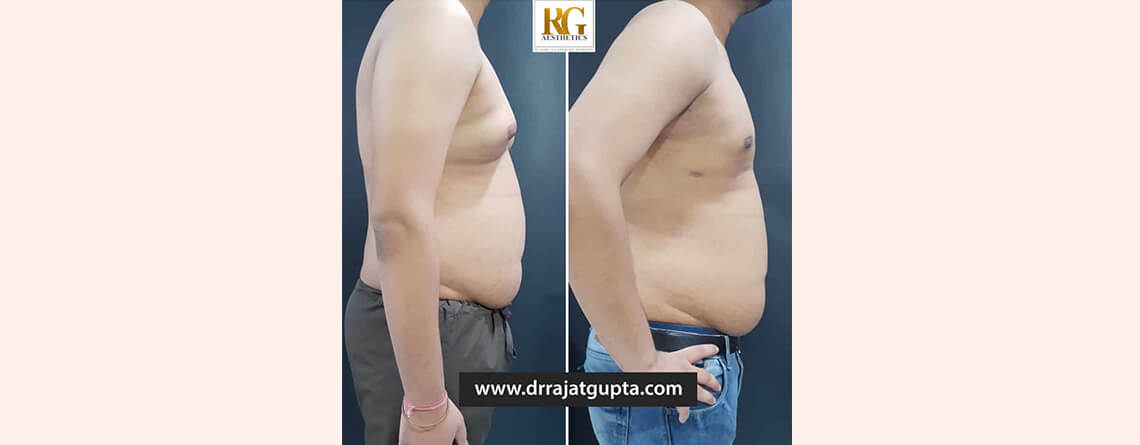 How is Scarless Gynecomastia Surgery Possible in India?