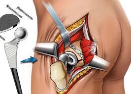 Advanced Hip Surgery for Pain Free Movement: – @drshekhar on Tumblr