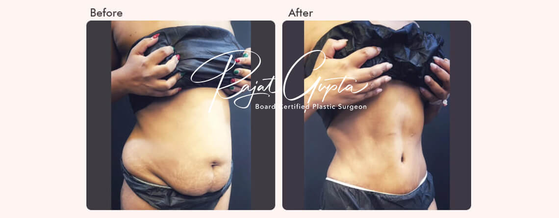 Latest Tummy Tuck Surgery Techniques Available Today