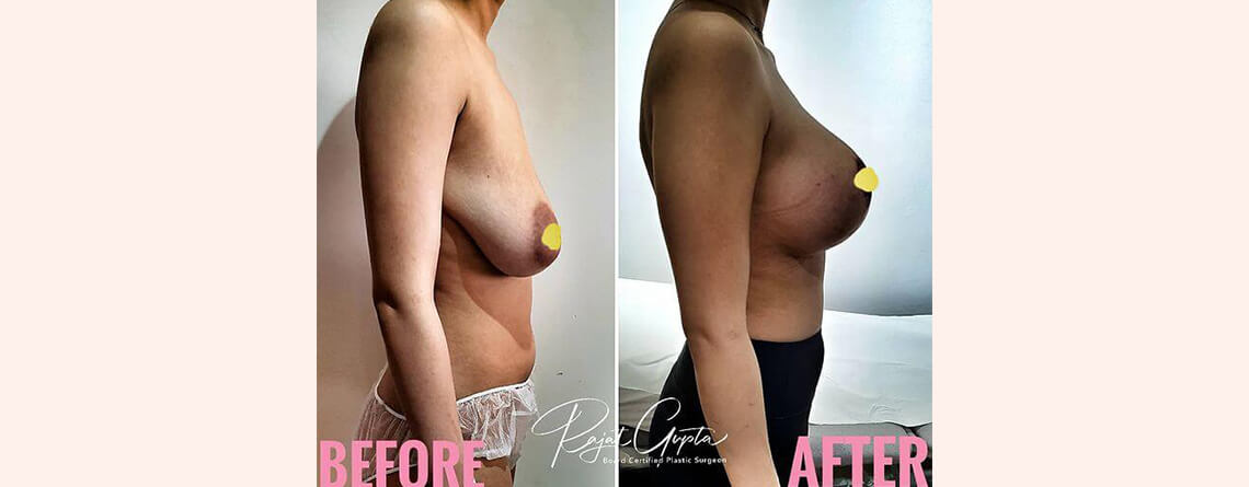 What You Need to Know About Breast Lift Scars?