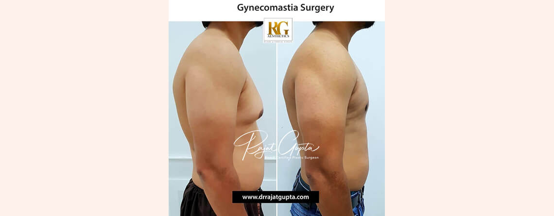 Is Gynecomastia a Big Surgery? What You Should Really Expect