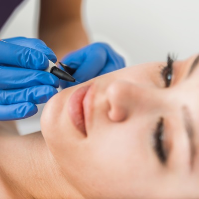 Thread vein removal with Advanced Electrolysis at True Medispa