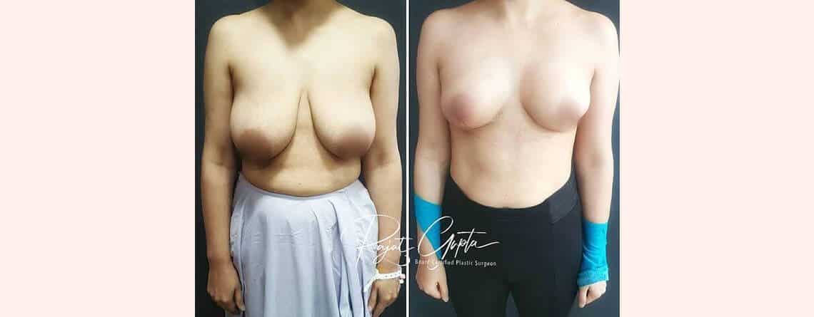 Breast Lift Surgery in Delhi: Techniques Explained | Dr Rajat Gupta