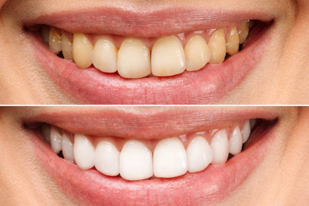Radiant Smiles Start Here: How to Keep Your Teeth White Naturally and Safely