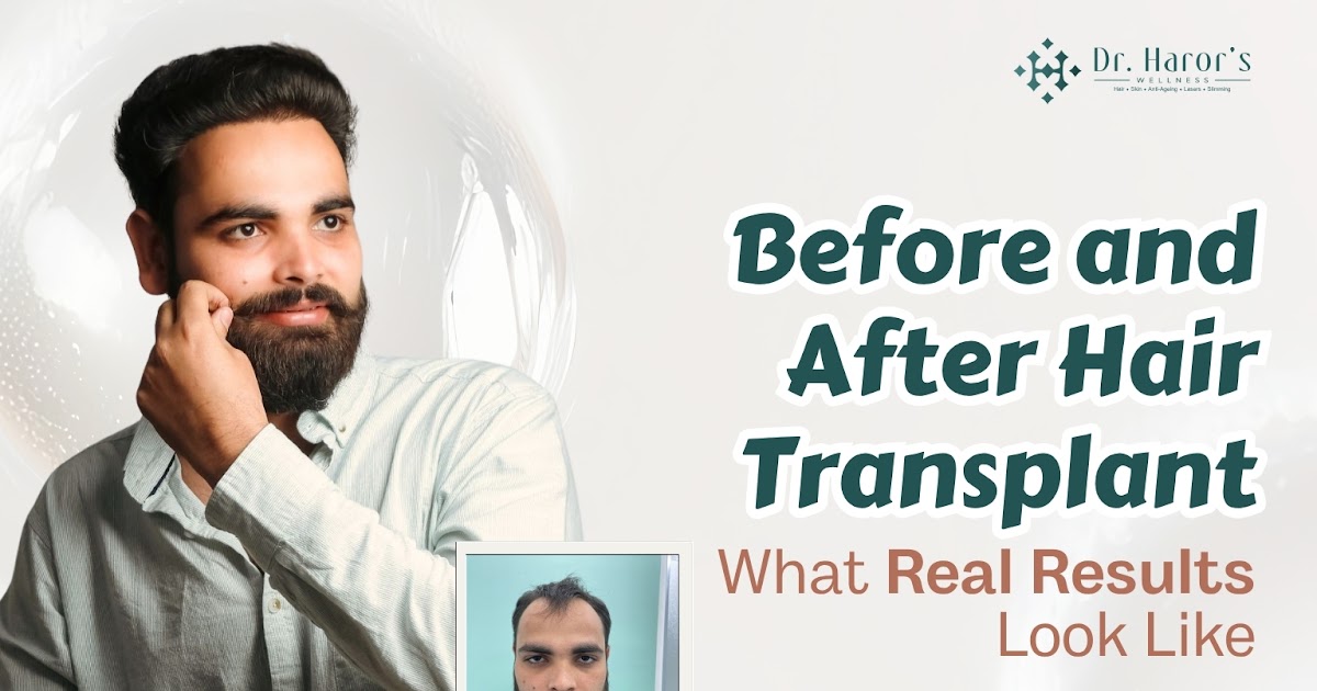 Before and After Hair Transplant: What Real Results Look Like