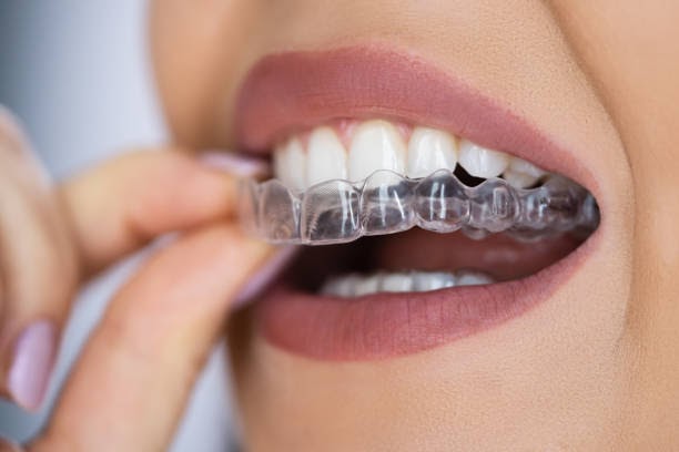 Elevate Your Smile with Innovative Clear Aligner Treatment