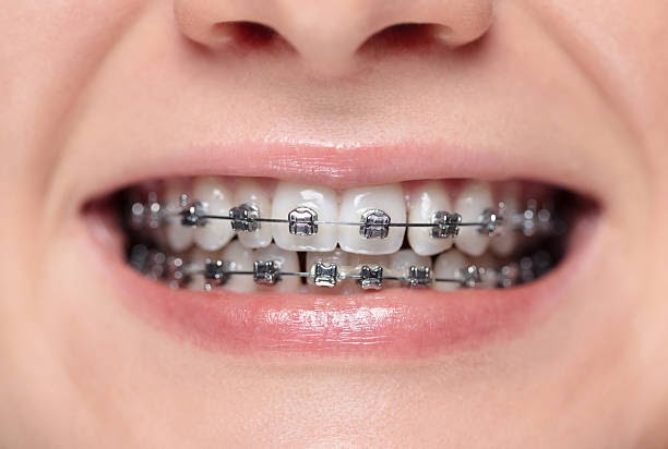 Smile Innovation in the City: Why More Families Are Choosing Northwest Portland Braces