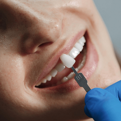 Dental Veneers in Islamabad, Pakistan