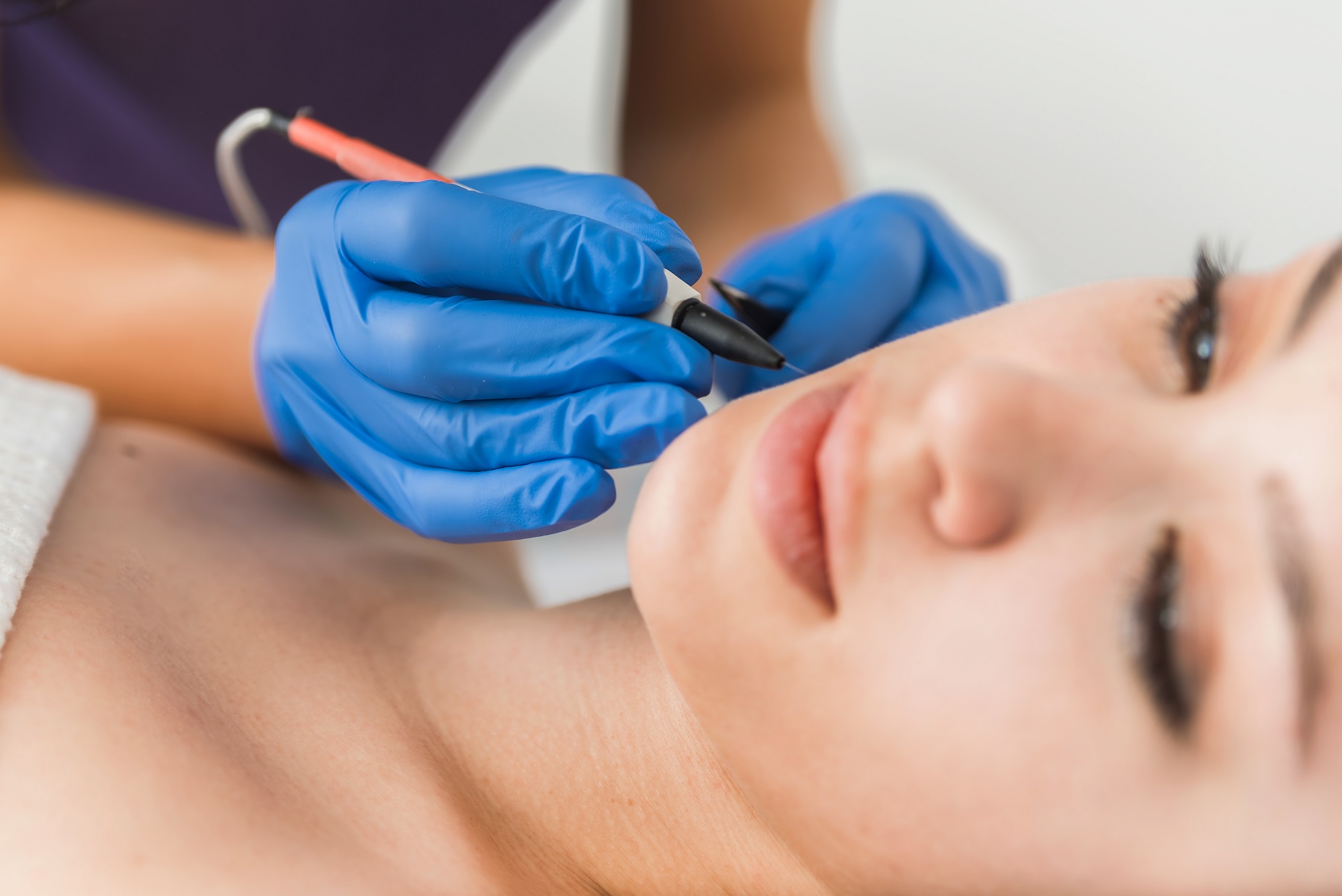 Permanent Hair Removal with Electrolysis in MK | Best Electrology