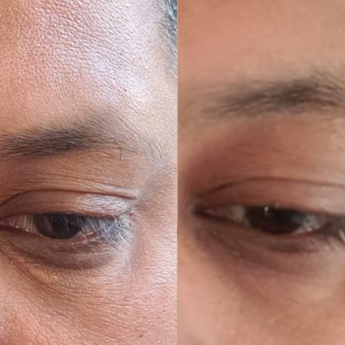 Best Xanthelasma Removal Treatment in Milton Keynes